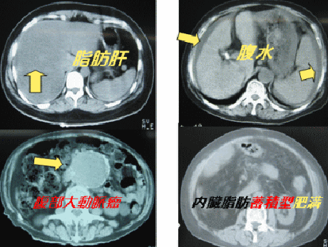 腹部CT